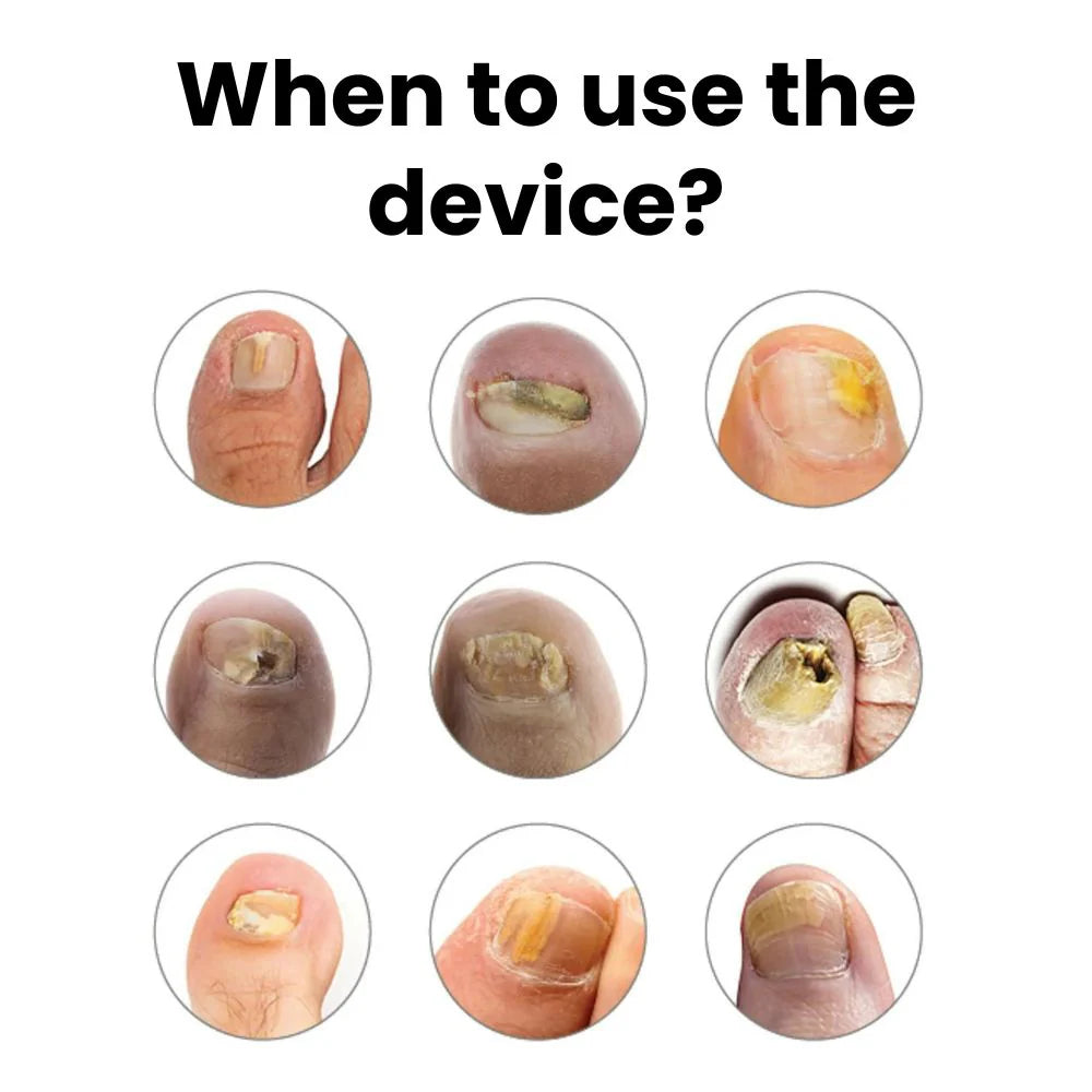 Auroxen Anti-Fungal Nail Treatment Device