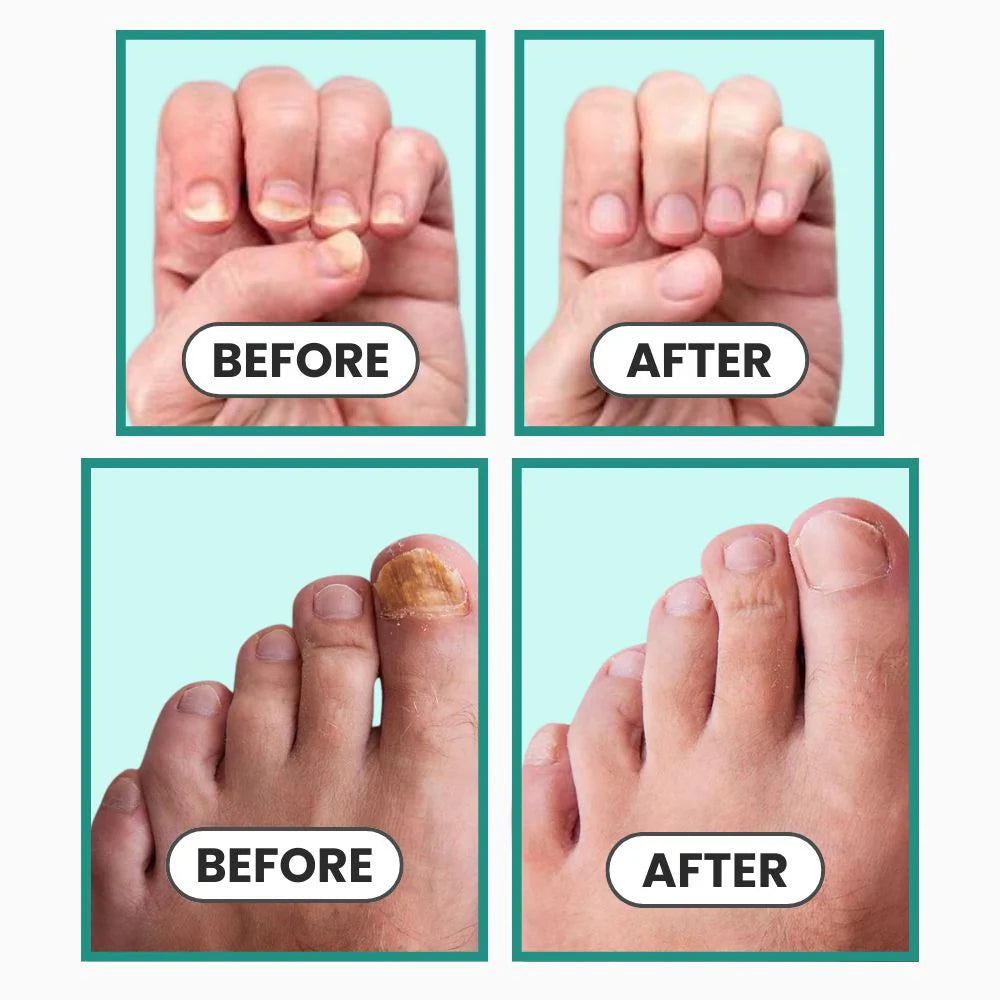 Auroxen Anti-Fungal Nail Treatment Device
